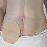 ilestoma